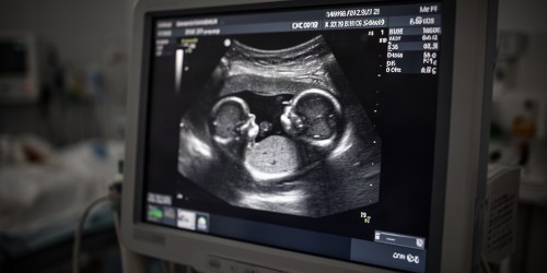 Gêmeos em risco: o que é a síndrome da transfusão feto-fetal?