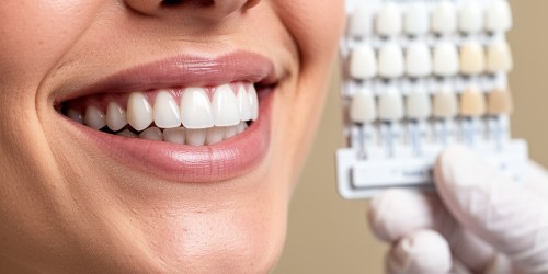 Lente Dental ou Clareamento: Qual Fazer Primeiro?