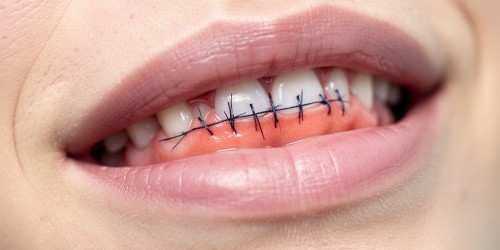 Pontos na Boca: Cuidados Após Cirurgia