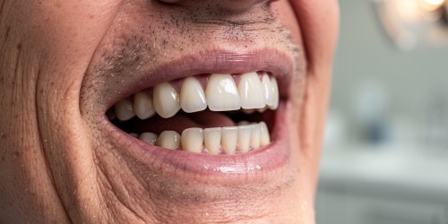 Prótese Dentária Pode Melhorar a Fala?