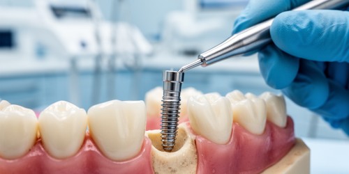 Implante Imediato Após Extração: Vantagens e Cuidados
