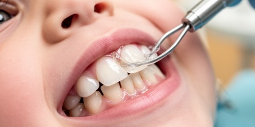 Selante Dentário Infantil: Para Que Serve?