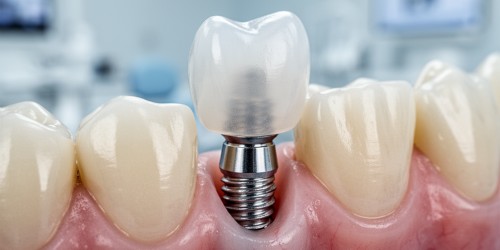 Implante com Dente Provisório: Como Funciona?