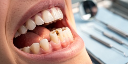 Quanto Tempo Depois de Perder um Dente Posso Fazer Implante?