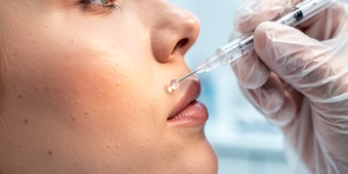 Preenchimento Facial com Ácido Hialurônico