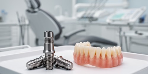 Implante Dentário ou Dentadura: Qual Escolher?