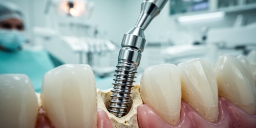 Carga Imediata em Implante Dentário: O Que é?