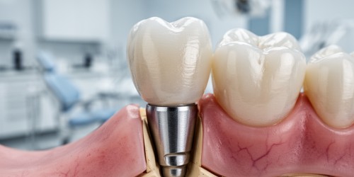 Prótese Fixa Sobre Dentes ou Sobre Implantes: Entenda