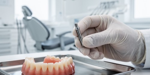 Como Trocar Dentadura por Implantes Dentários