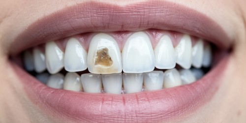 Dente Escuro na Frente: Como Resolver?