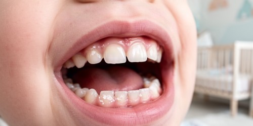 Cárie de Mamadeira: O Que é e Como Prevenir