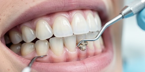 Tártaro nos Dentes: Como Remover com Segurança