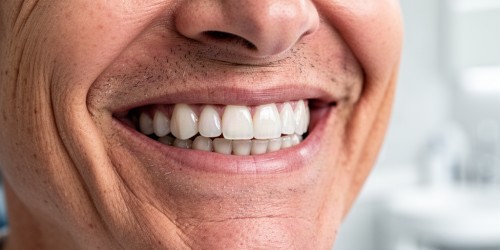 Implante Dentário Fixo: Vantagens para Quem Perdeu Dentes
