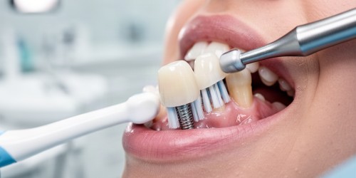 Como Higienizar a Boca Depois do Implante Dentário