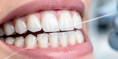 Cárie Entre os Dentes: Como Descobrir?