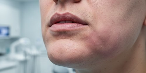 Sinais de Alerta Após o Implante Dentário