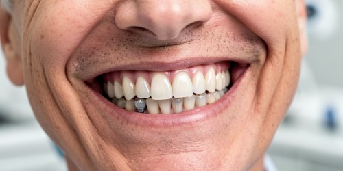 Implante Dentário para Quem Usa Dentadura