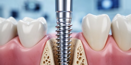 Implante Dentário Substitui a Raiz do Dente?