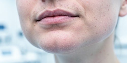 Inchaço Depois do Implante Dentário é Normal?