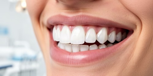 Clareamento Dental e Restaurações: O Que Saber